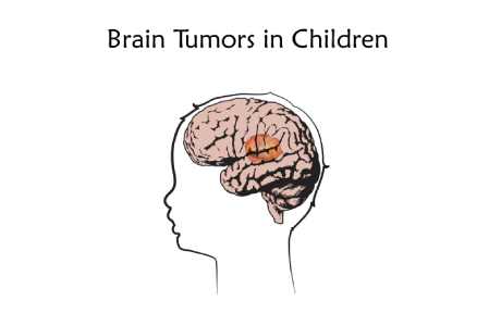 Craniosynostosis Image