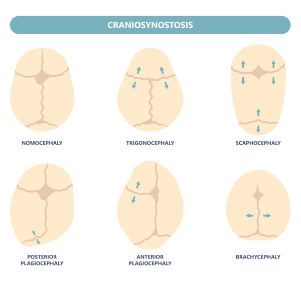 Craniosynostosis Image