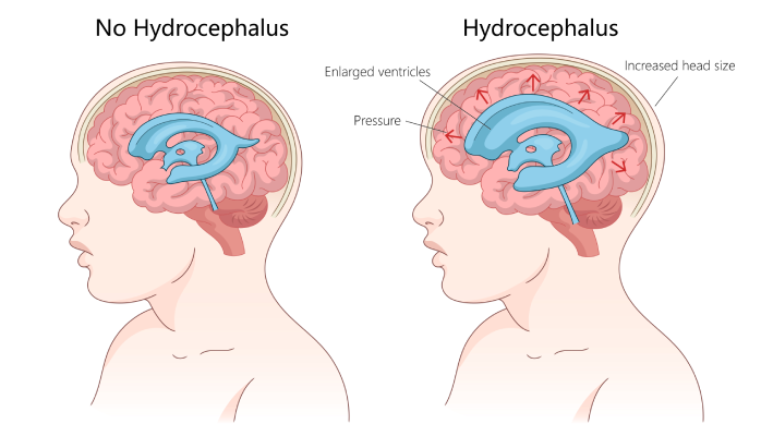 hydrocephalus