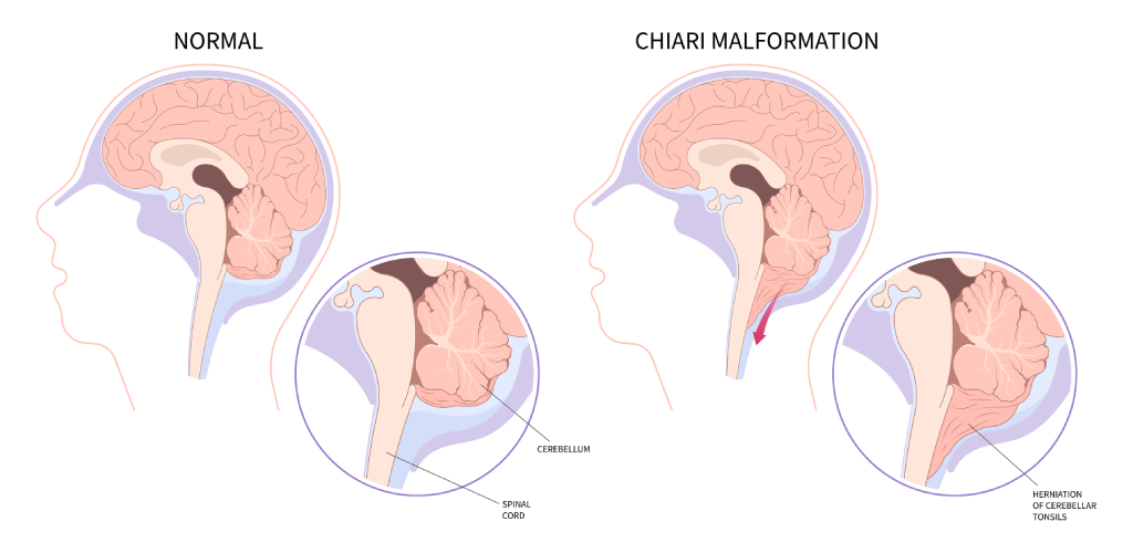 Malformation