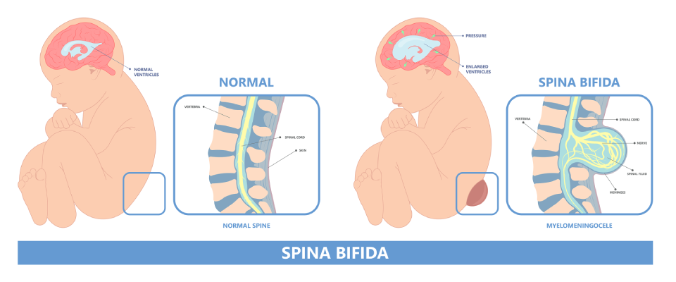 Spina Bifida